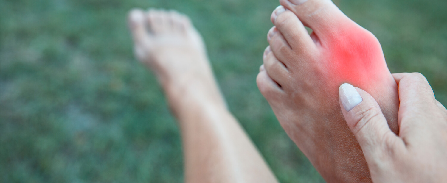 Bunion Pain Symptoms and Treatment | Dundas University Health Clinic