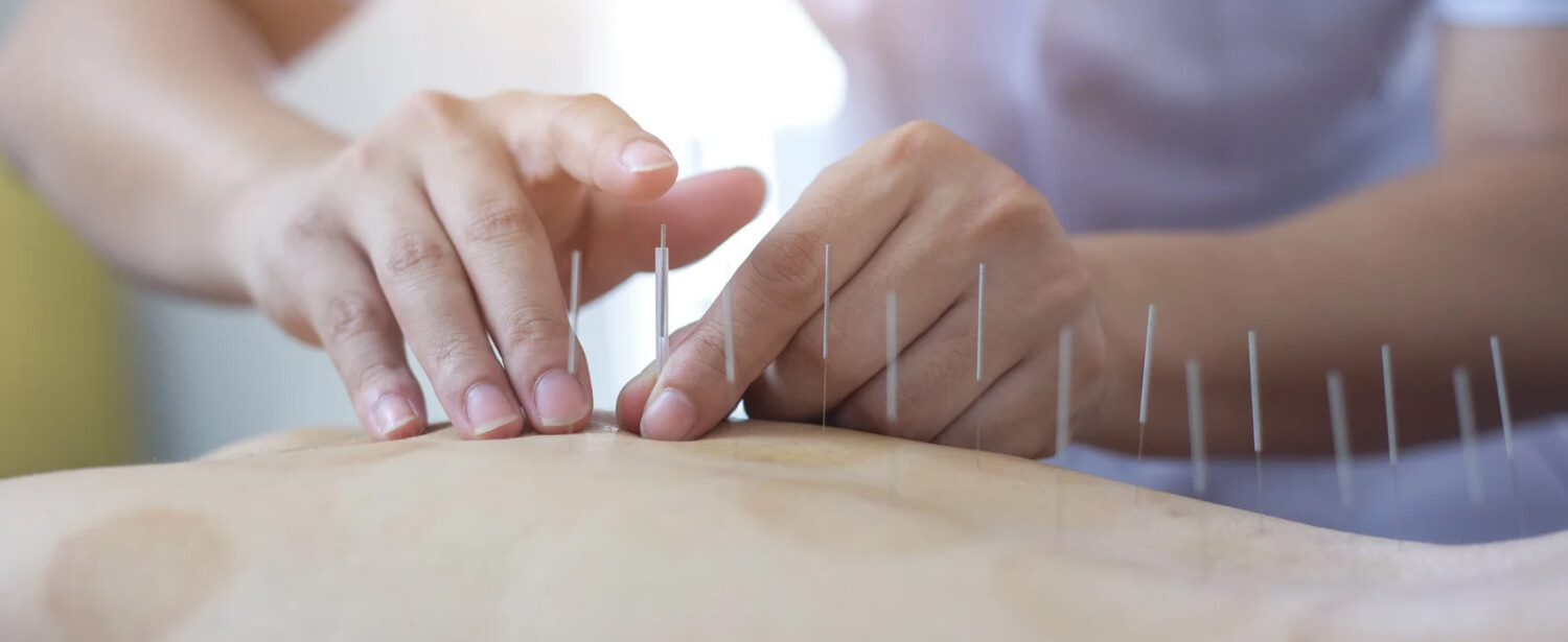 TCM Acupuncture | Dundas University Health Clinic