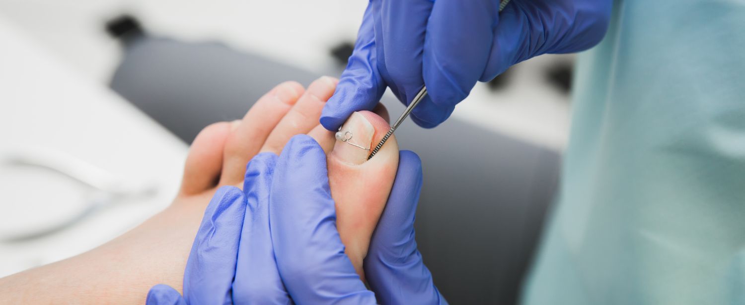 Toronto Chiropodists For Ingrown Toenail | Dundas University Health Clinic